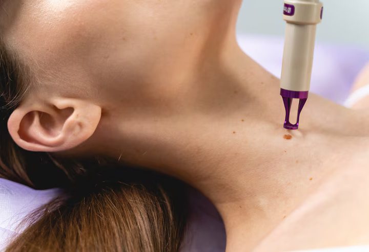 Mole Removal Skin Care After Removal