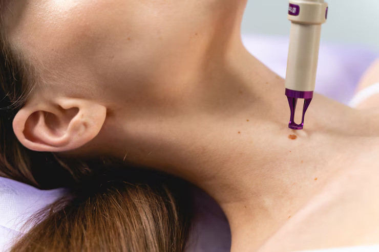 Mole Removal Skin Care After Removal